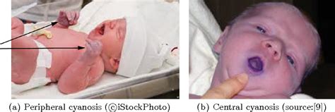 Figure 1 from Designing preterm neonatal cyanosis simulation | Semantic ...