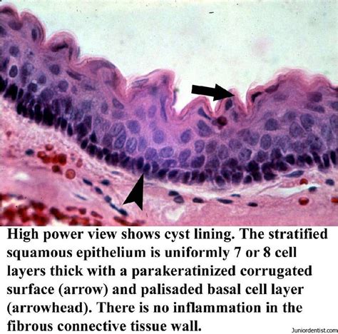 Globulomaxillary Cyst Histology