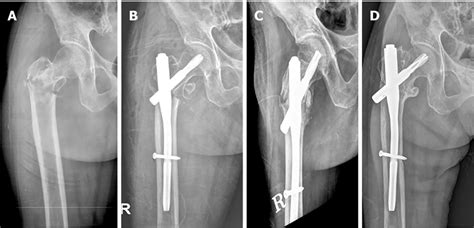 Radiographic results. A: A preoperative radiograph shows an ...