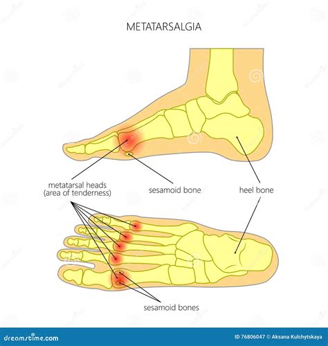 [DIAGRAM] The Arches Of Foot Diagram - MYDIAGRAM.ONLINE