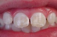 Pediatric Dentistry: White Spots On Teeth-Enamel Hypoplasia