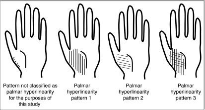 Diagrammatic representation of the patterns of palmar skin markings ...