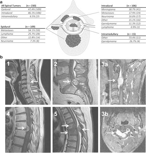 Overview of spinal tumors leading to spinal cord compression in our... | Download Scientific Diagram