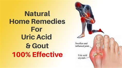 Uric Acid Treatment Naturally At Home | Causes, Symptoms of Uric Acid - YouTube