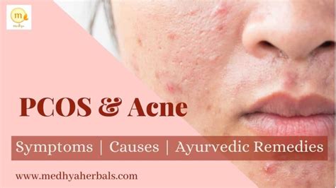 PCOS Acne Treatment in Ayurveda: A Doctor's Guide