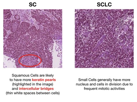 Lung Cancer Histology Image Classification with Convolutional Neural ...