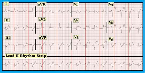 ECG Interpretation: ECG Interpretation Review #49 (Chest Pain - STEMI - Culprit Artery - LAD ...