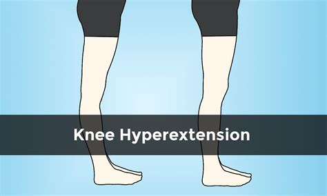 Fixing Knee Hyperextension Posture | Hyperextended knee, Knee exercises ...