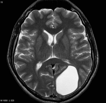 Neuroglial Cyst