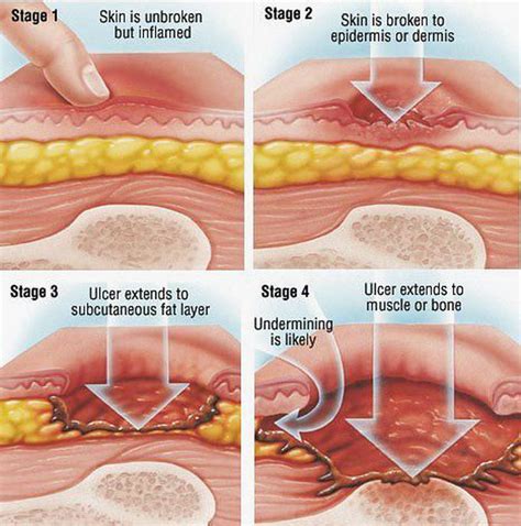 Bed Sores Decubitus Ulcers Stages Causes Symptoms Treatment Dr | Sexiz Pix