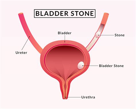 Bladder Stones | Symptoms Causes Prevention | Optimists Healthcare