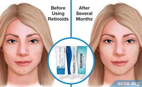 Tretinoin Before And After Acne