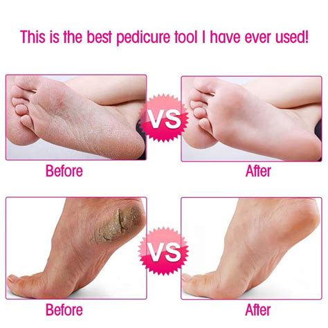 Callus Remover - Foot Callus Remover – Gear Tech UK