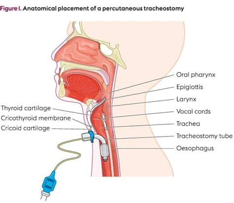 REBEL Core Cast 12.0 - Tracheostomy Emergencies - REBEL EM - Emergency Medicine Blog