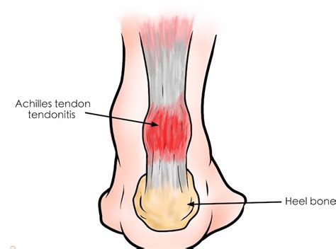 Achilles Tendonitis: The Injury Every Runner Should Test For - Painfree Maverick