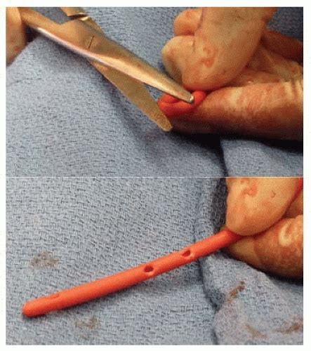 Feeding Jejunostomy | Basicmedical Key