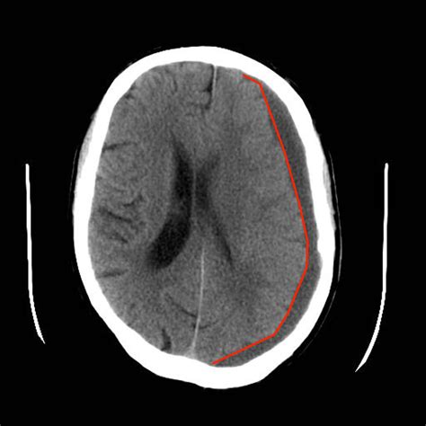 Subdural Haemorrhage | Intracranial Haemorrhage | Geeky Medics