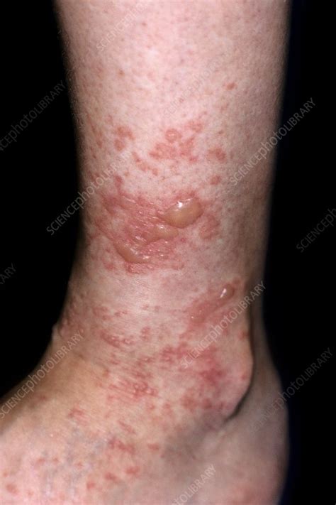 Bullous eczema - Stock Image - C016/6717 - Science Photo Library