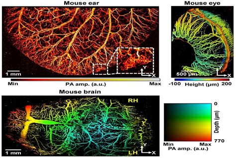 Super-resolution photoacoustic microscopy finds clogged blood vessels