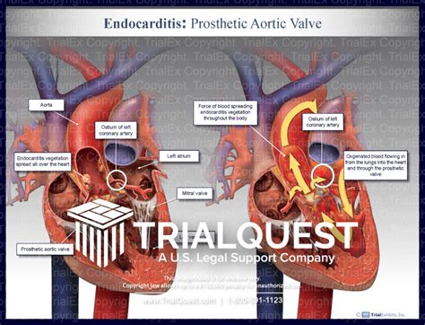 Endocarditis: Prosthetic Aortic Valve - TrialQuest Inc.