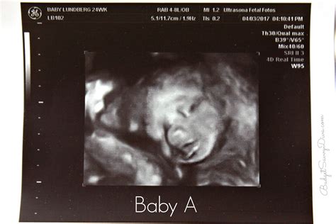 3D Ultrasound of The Twins - Budget Savvy Diva