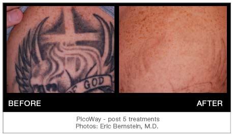 PicoWay Advanced Laser Tattoo Removal • Lakes Dermatology