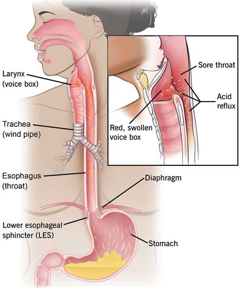 Esophageal stricture causes, symptoms, diagnosis, treatment & prognosis