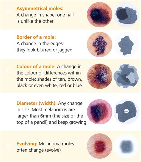 Signs Of Melanoma Skin Cancer