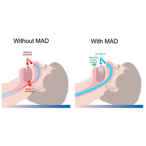 Sleep Apnea Treatment in Aldershot, Burlington