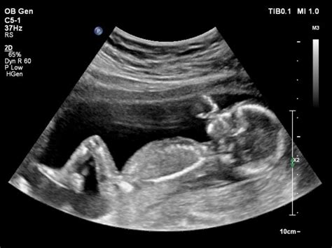 16 week ultrasound with a boy! - Page 2 - BabyCenter