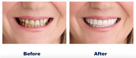 What is Snap-on Smile: Benefits, Procedure, Cost, Durability