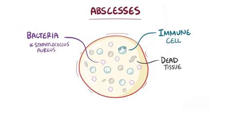 Perinephric Abscess: What Is It, Causes, Diagnosis, Treatment, and More ...