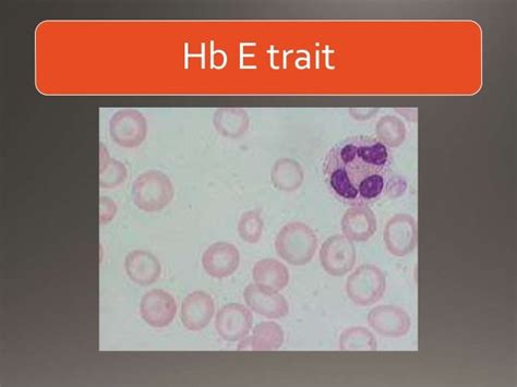 Hemoglobinopathies - Lab diagnosis