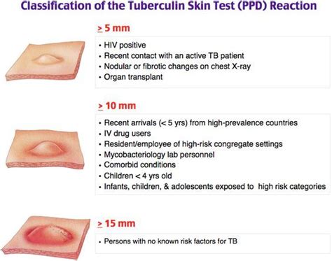 ผลการค้นหารูปภาพสำหรับ tuberculin skin test positive | Dermatology, Medical knowledge, Pulmonology