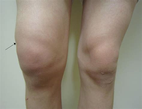 Swollen knee | Mexico| PDF | PPT| Case Reports | Symptoms | Treatment