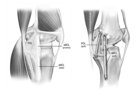 Researchers at the Steadman Philippon Research Institute Develop New ...