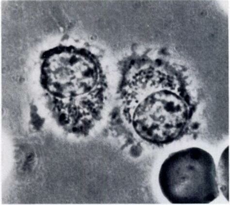 Peripheral blood film of supravital preparation observed under... | Download Scientific Diagram