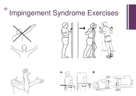 Subacromial Impingement Syndrome Geeky Medics | The Best Porn Website