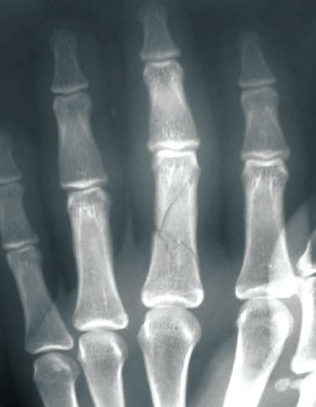 (Case 3) Fracture of proximal phalanx | Download Scientific Diagram