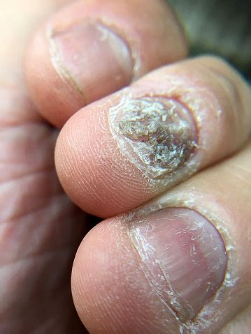 Big Close Up Of Fungus Infection On Nails Hand Finger With ...