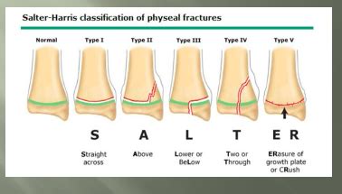 Weber classification of ankle fractures – Artofit