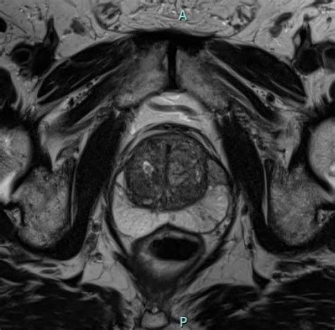 What To Expect During MRI Screening for Prostate Cancer — Radiology ...