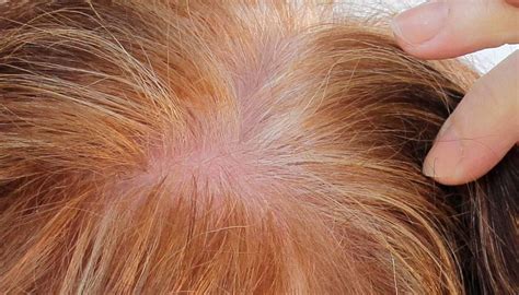 PRP for hair loss: Does it work, and is it safe?