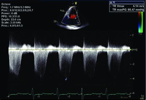 2: Echocardiogram showing flow across the tricuspid valve. Pulmonary... | Download Scientific ...