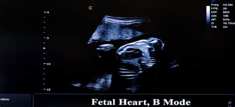 What Is Fetal Echocardiography – Purpose, Procedure & Risks | Being The Parent