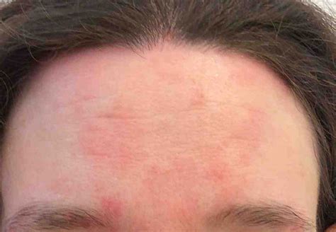 Seborrheic Dermatitis (Red Patches on Face) Treatment | Skin Specialists PC | LovelySkin™