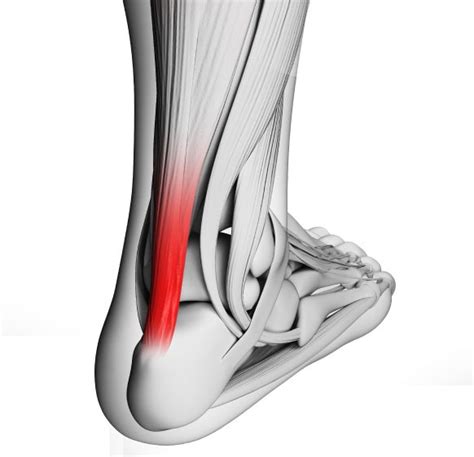 Achilles Tendon Pain — Fairfield Podiatry