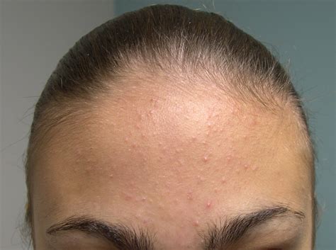 Medical Pictures Info – Types of Acne