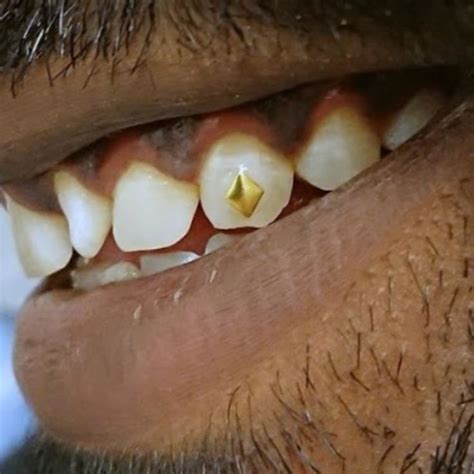 Gold Tooth Gems in 2020 | White gold teeth, Dental care clinic, Gold teeth