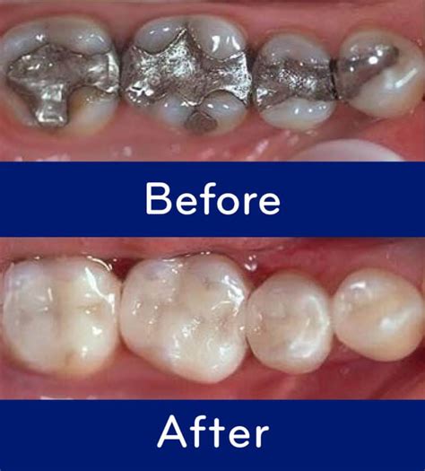 Mercury Amalgam Fillings Compared to Composites